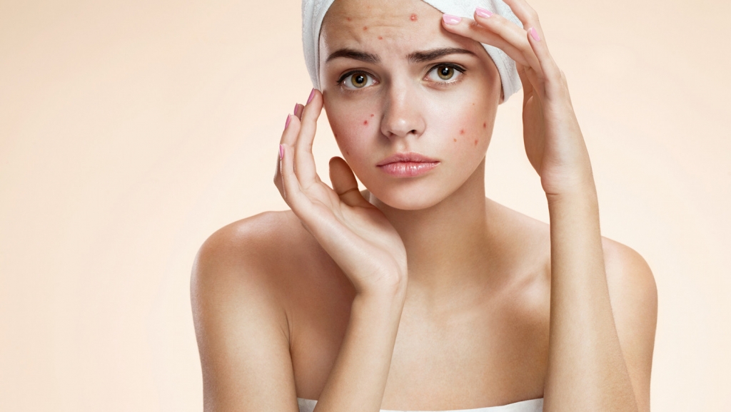 Que es el acne, ¿Qué es el acné?, Cliniderma