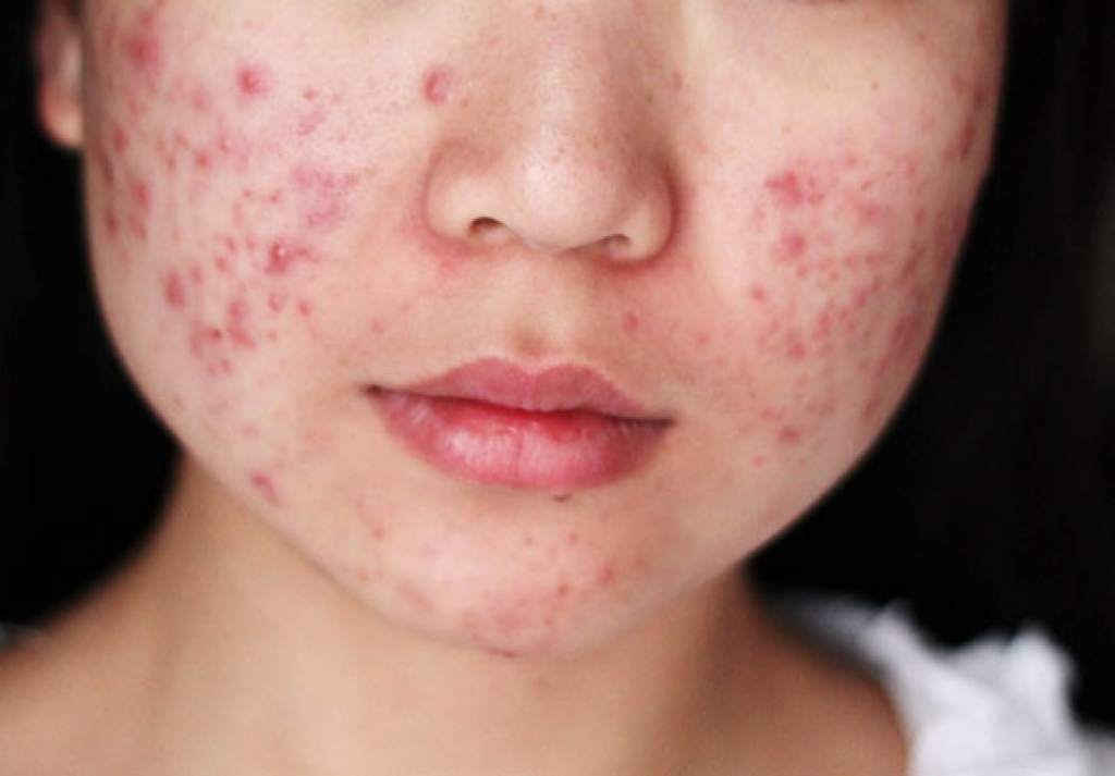consejos Prácticos Acné, Consejos prácticos si sufres de acné, Cliniderma 🥇