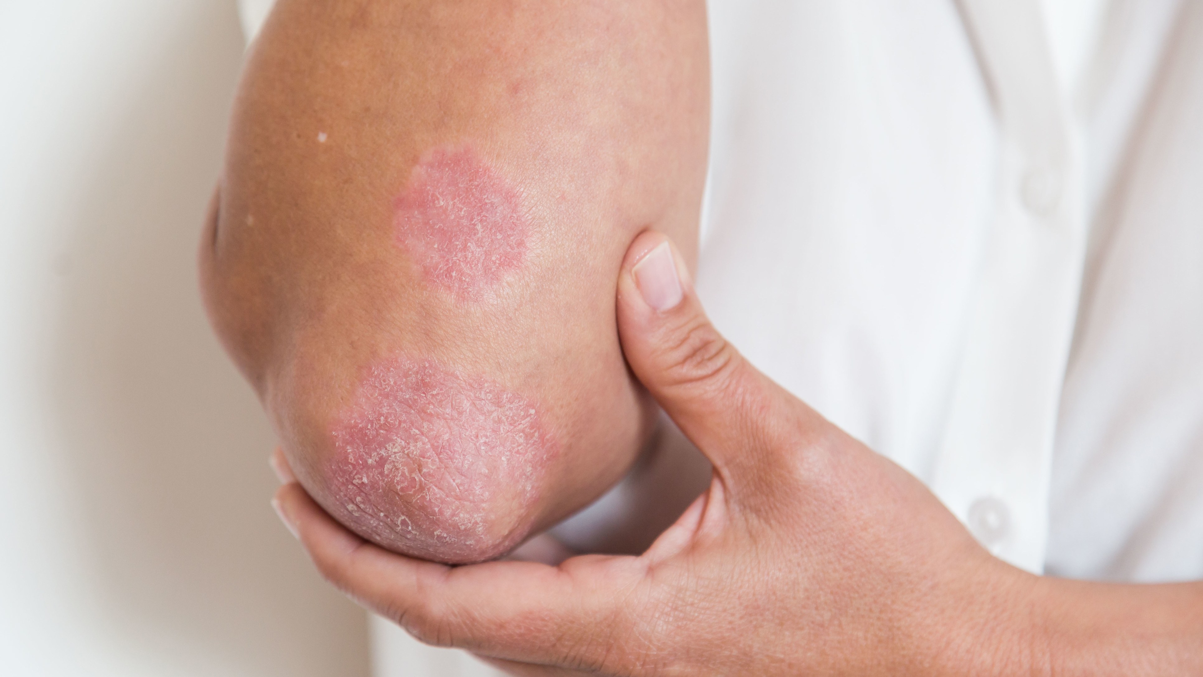 psoriasis pustulosa leve