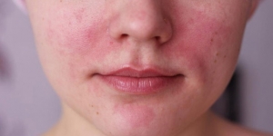 tratar a tiempo el acné, La importancia de tratar a tiempo el acné en adolescentes, Cliniderma 🥇