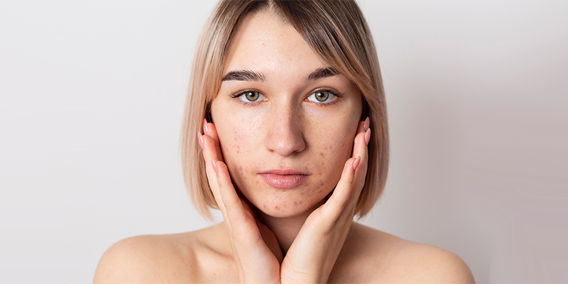 acné en adultos, ¿Sabías que el acné en mujeres adultas es más común de lo que se cree?, Cliniderma