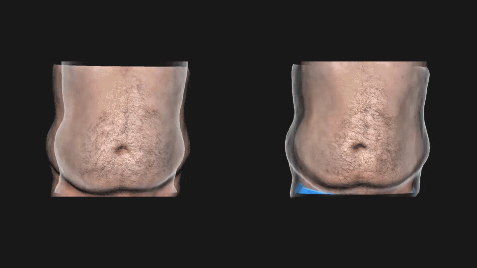 antes y después moldeamiento corporal