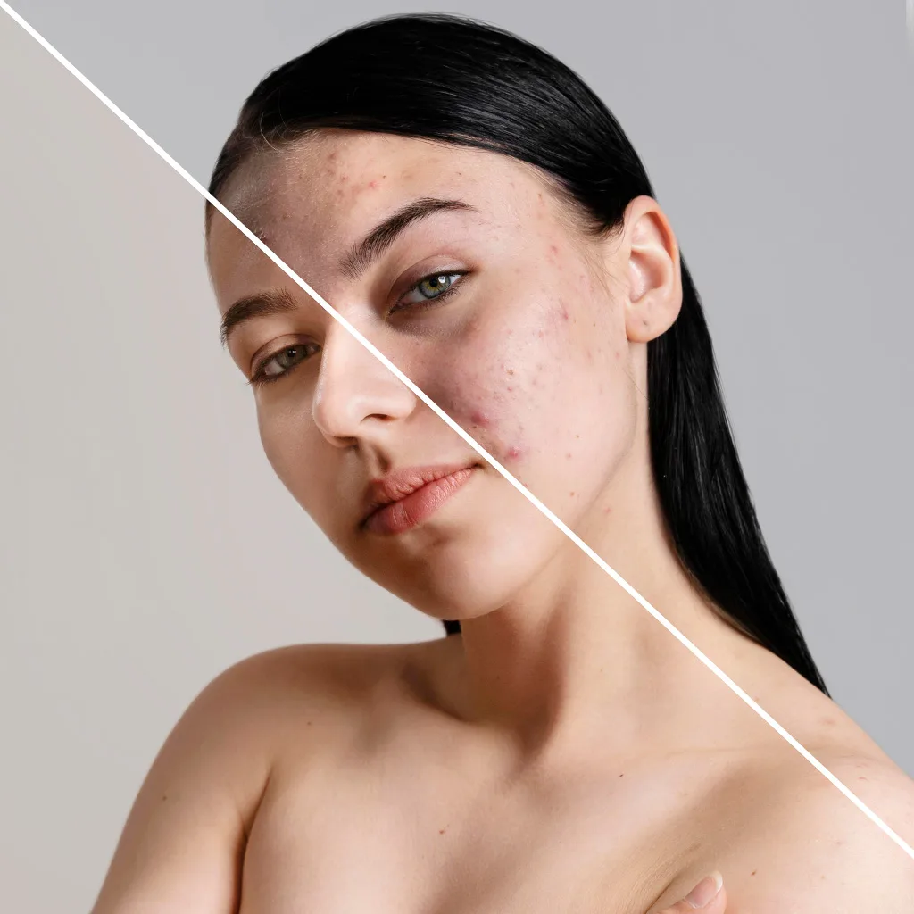 que es el acne