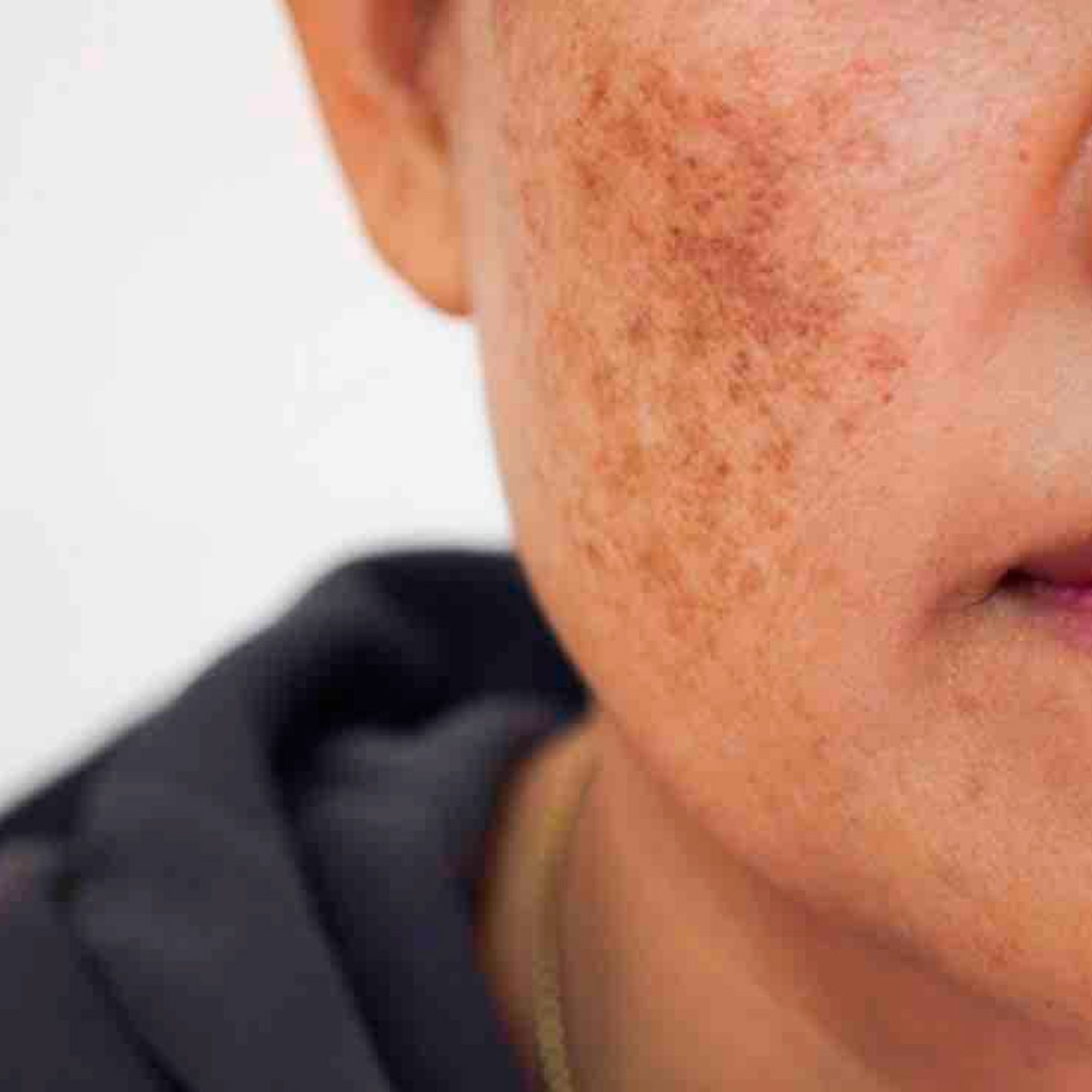 acne, Dermatología, Cliniderma 🥇