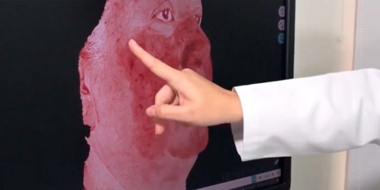 tratamiento para la rosacea