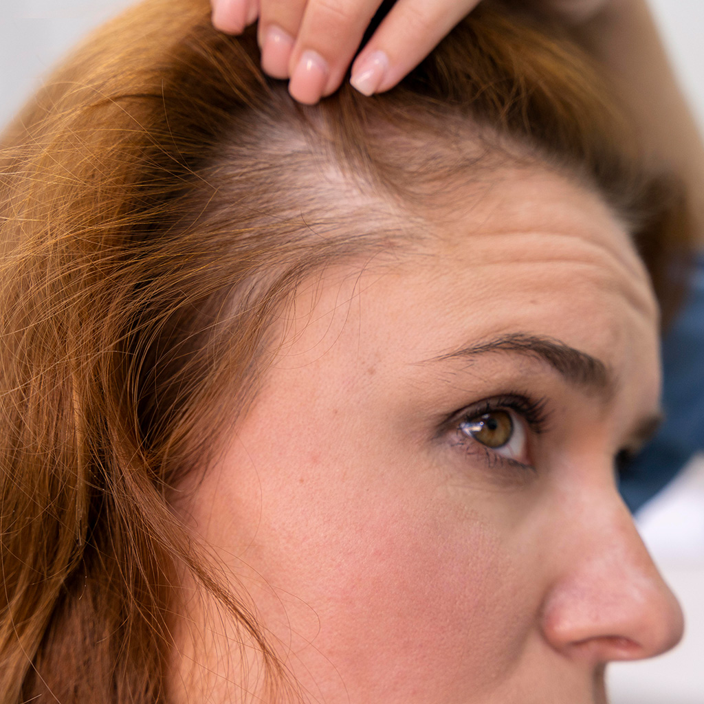 Caída de pelo, Tratamiento para la caída de pelo (Alopecia), Cliniderma 🥇