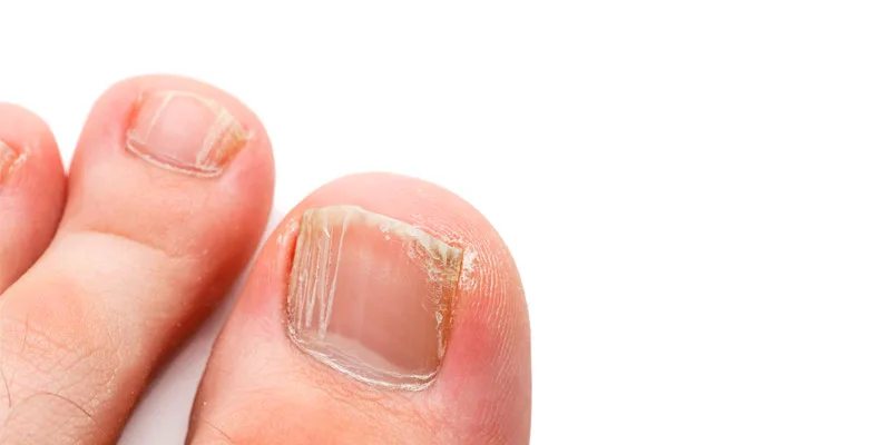 onicomicosis