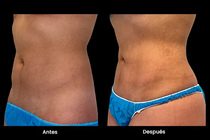 marcacion abdominal