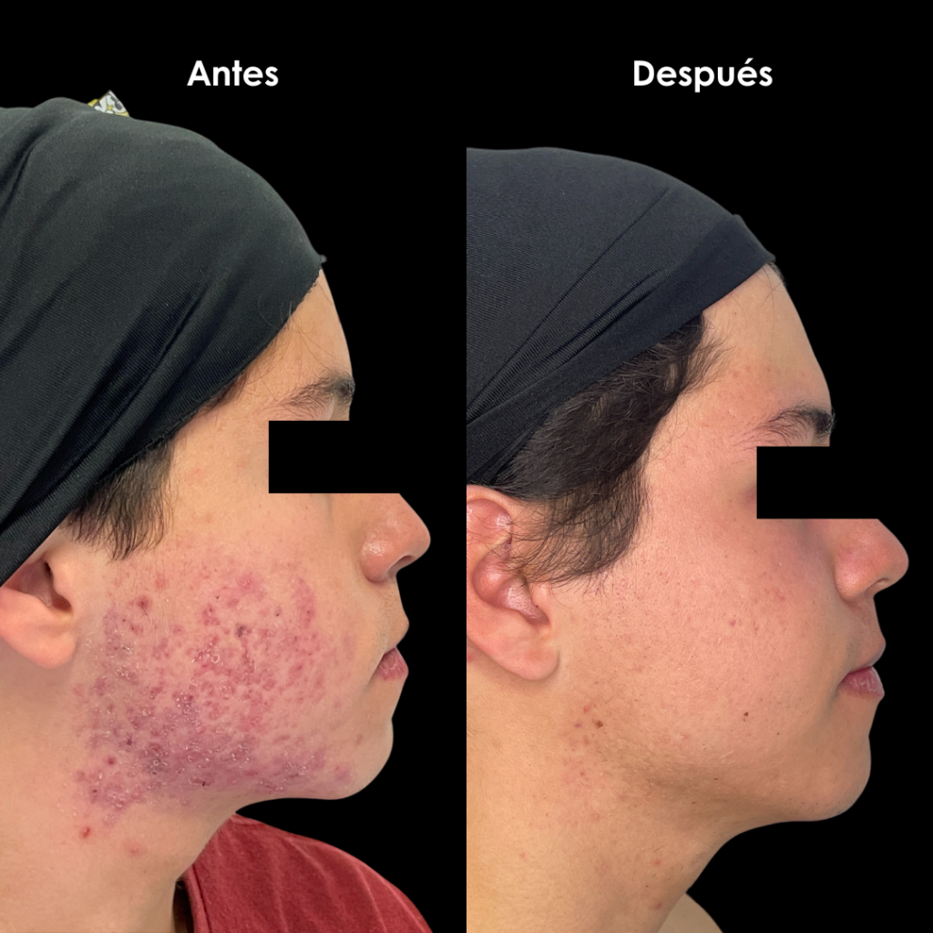 acne antes y despues