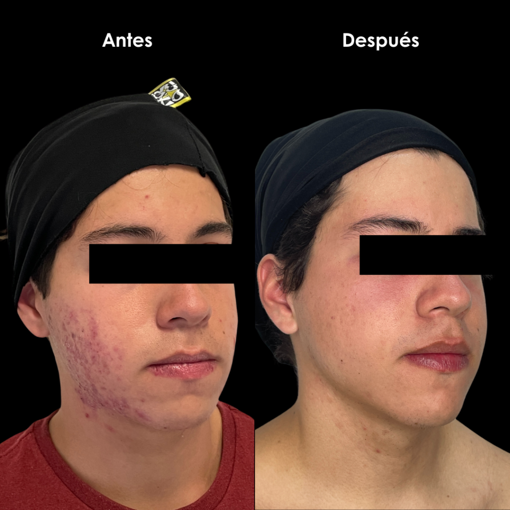 antes y despues