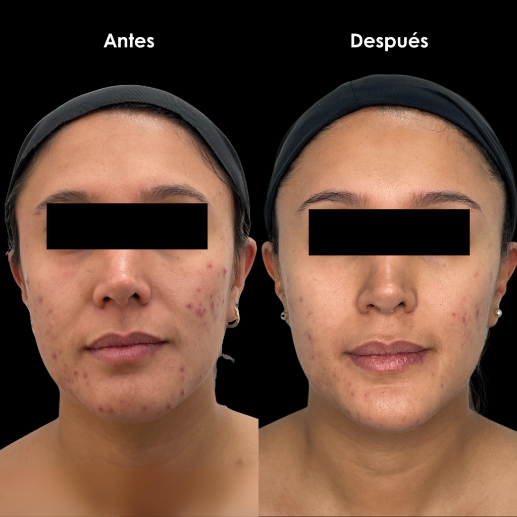 antes y despues acne