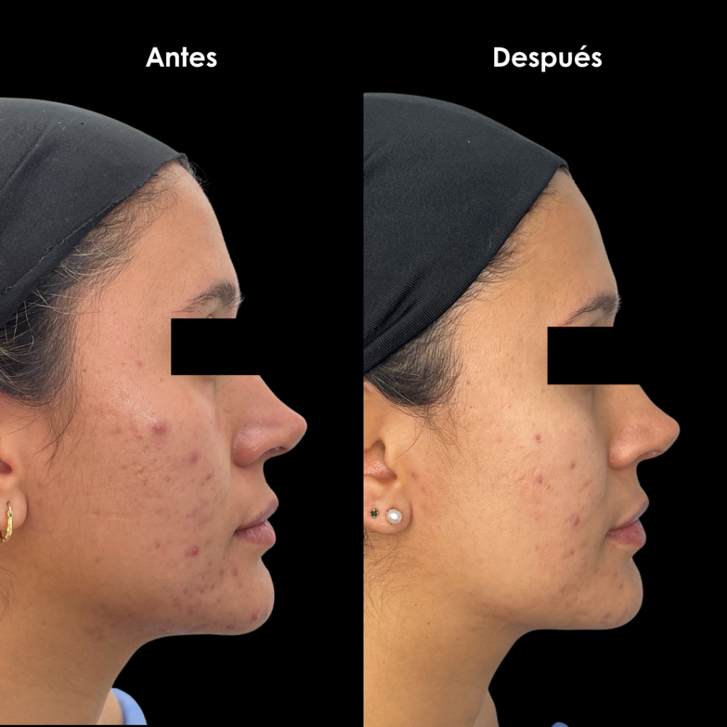 resultados acne