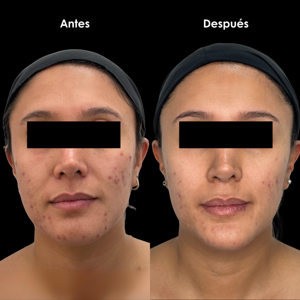 tratamiento acne opiniones