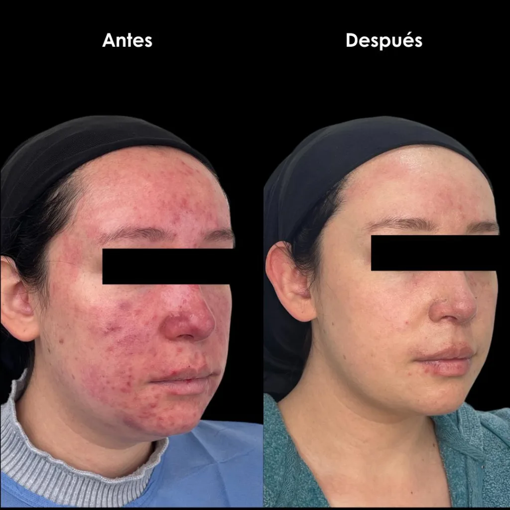 eliminar rosacea