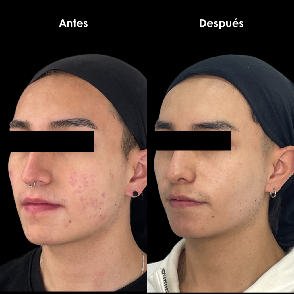 cicatrices de acne