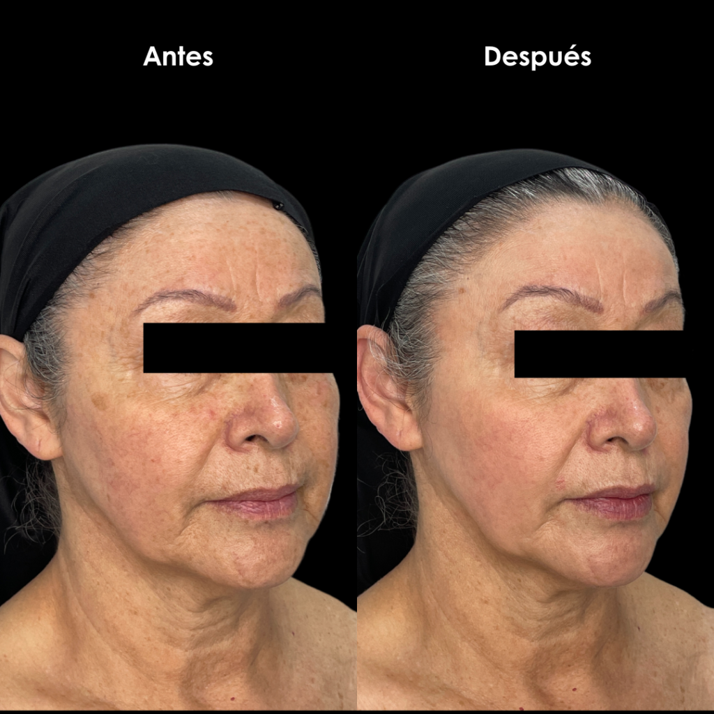 rejuvecimiento facial laser antes y despues