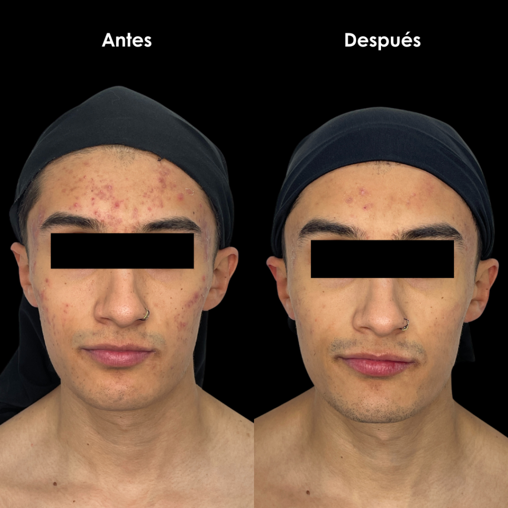 resultado de tratamiento acne