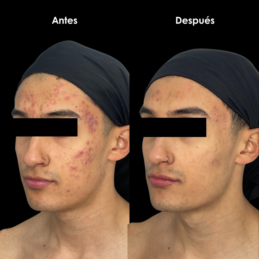 tratamiento acne antes y despues