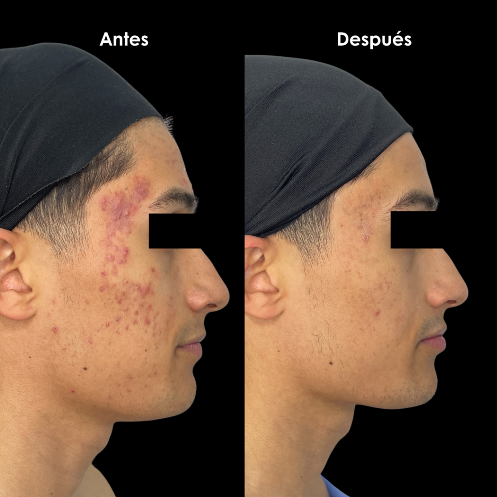 resultados de acne