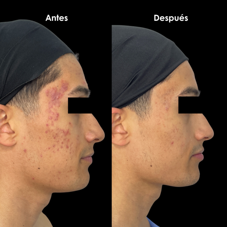 acne antes y despues