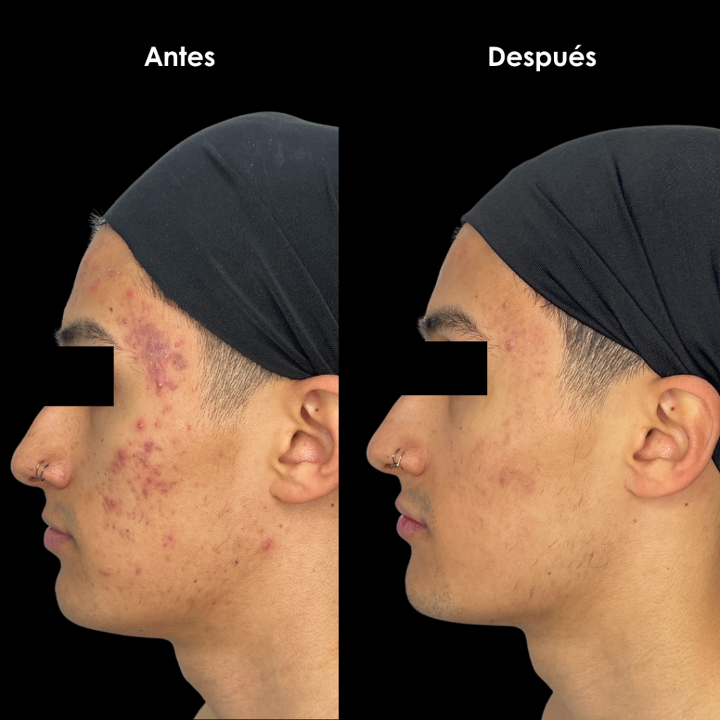 acne antes y despues