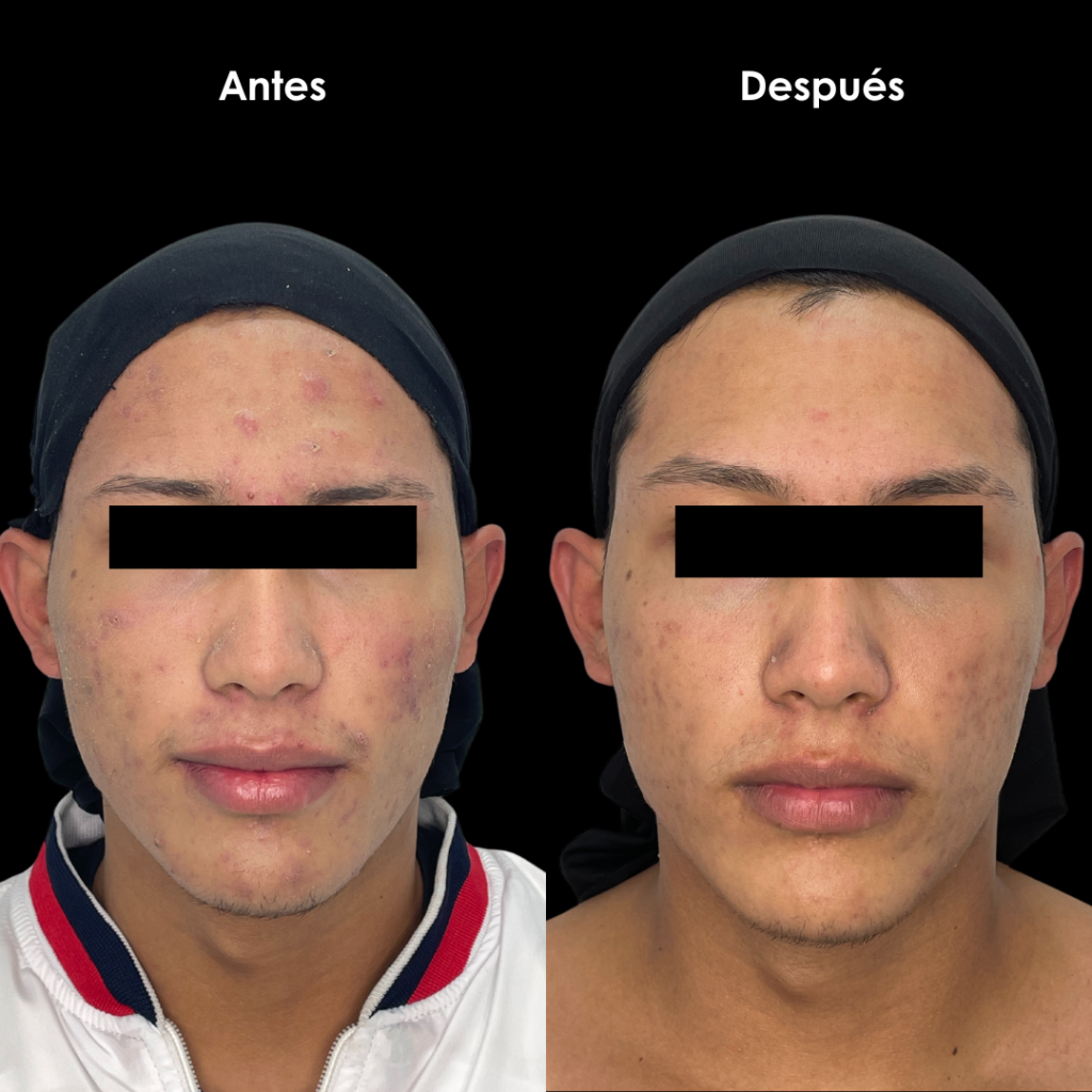 resultados de acne