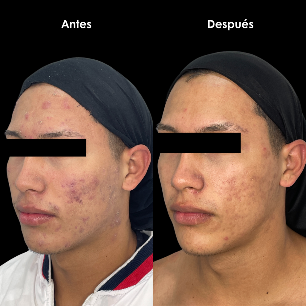 acne resultados bogota