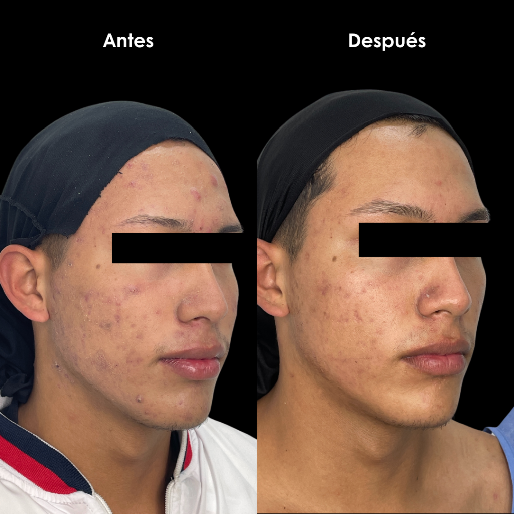 acne bogota ante sy despues