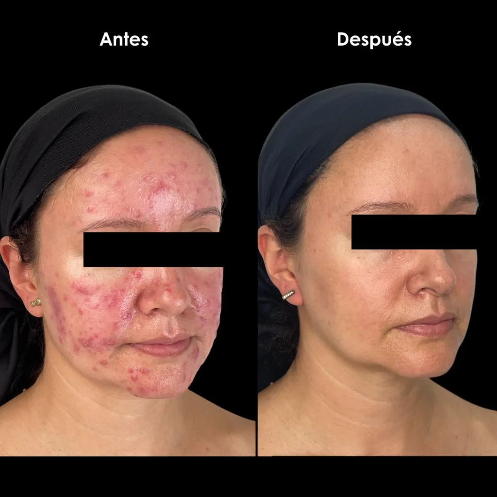 rosacea antes y despues