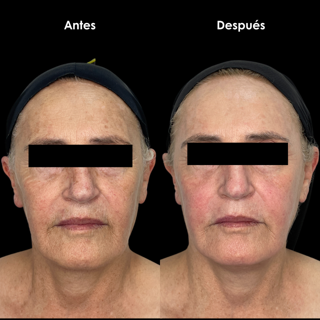 laser facial antes y despues