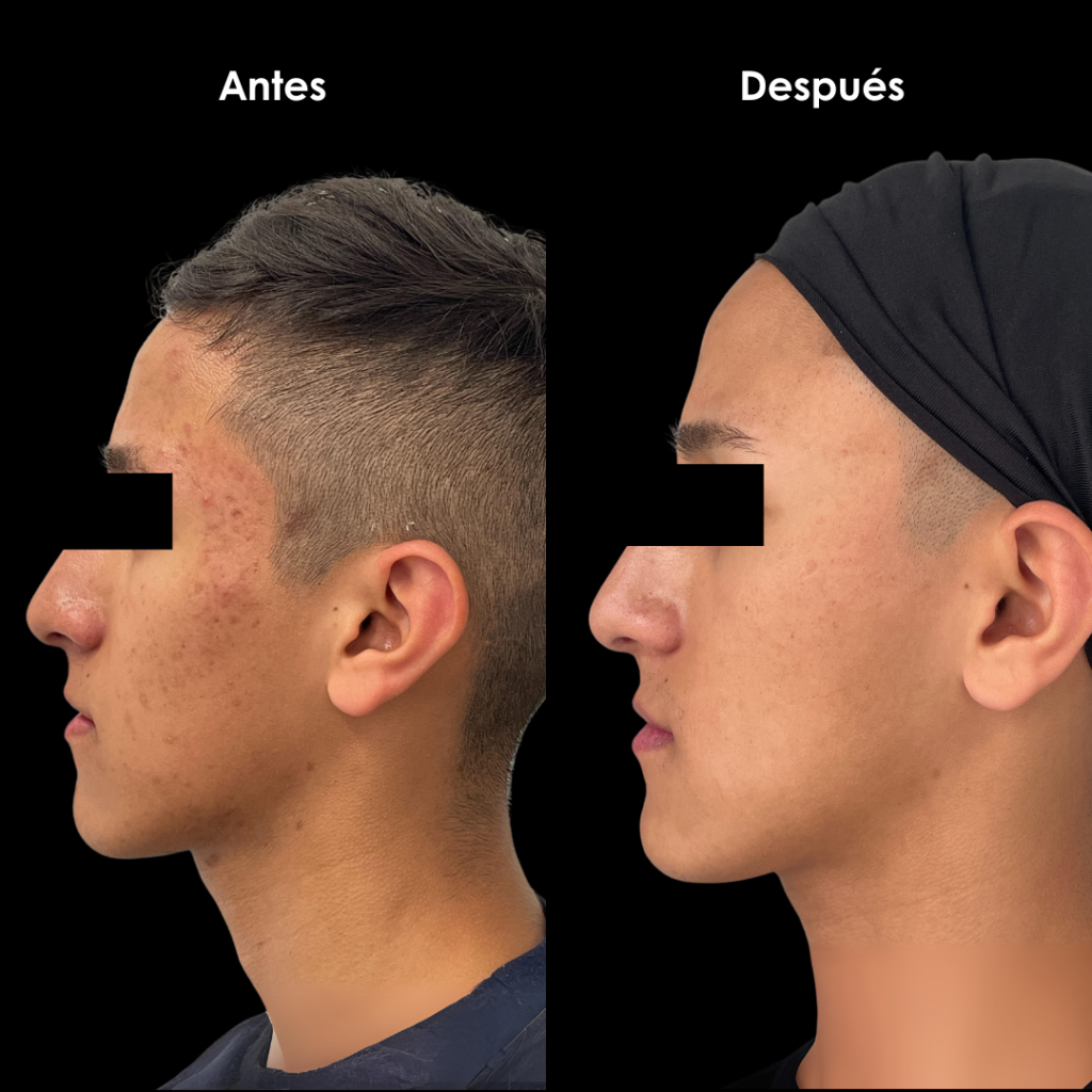 antes y despues cicatrices de acne