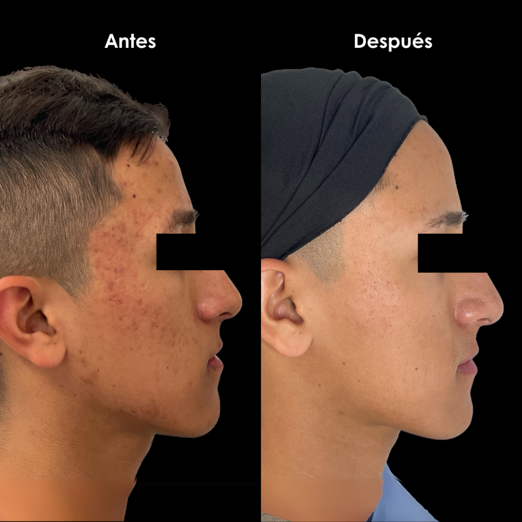 cicatrices de acne antes y despues