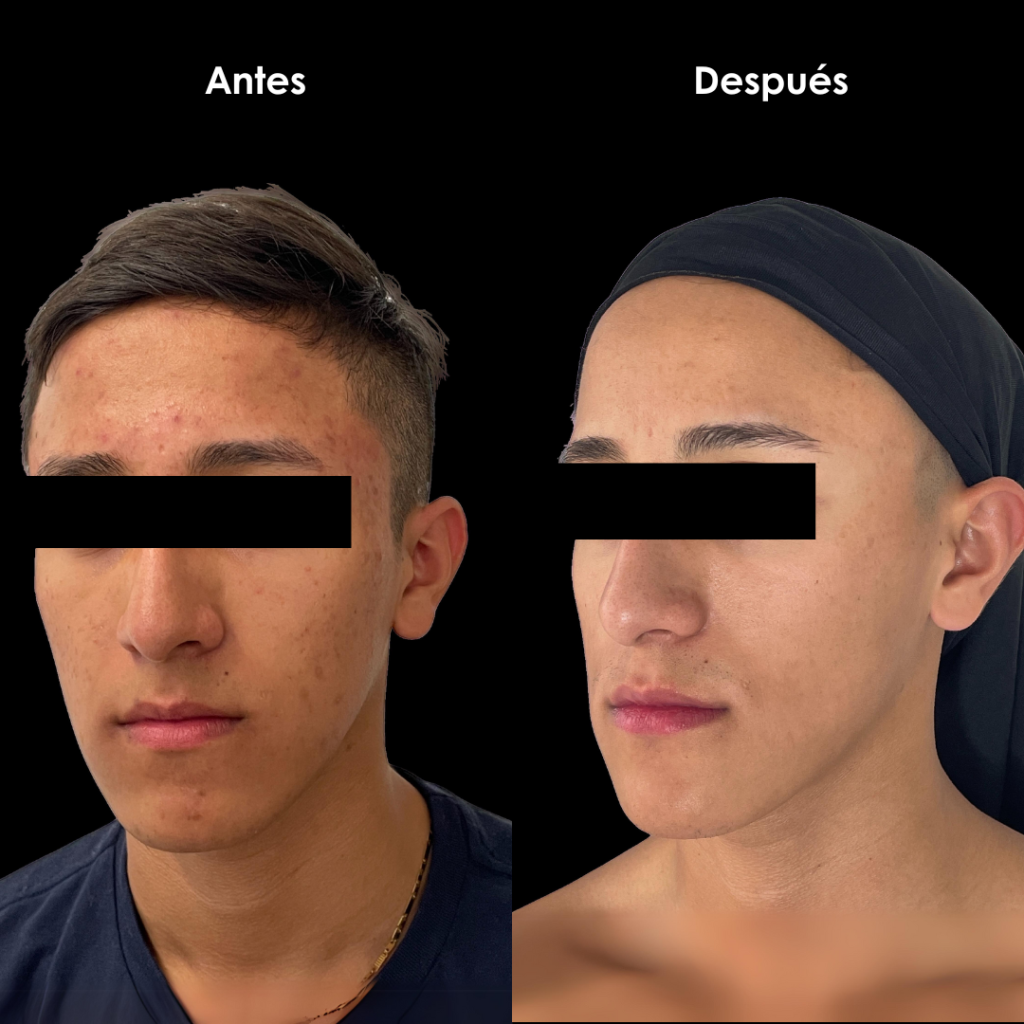 cicatrices de acne