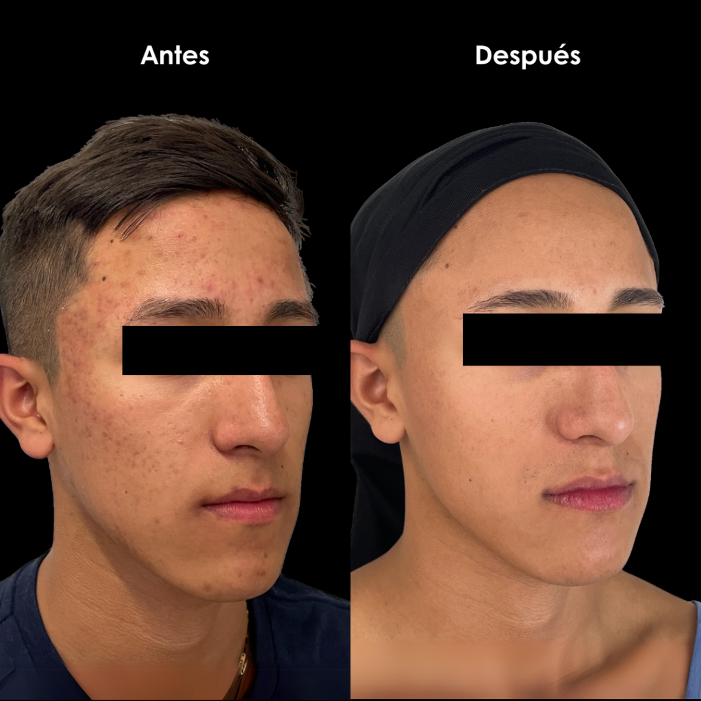 antes y despues cicatrices de acne