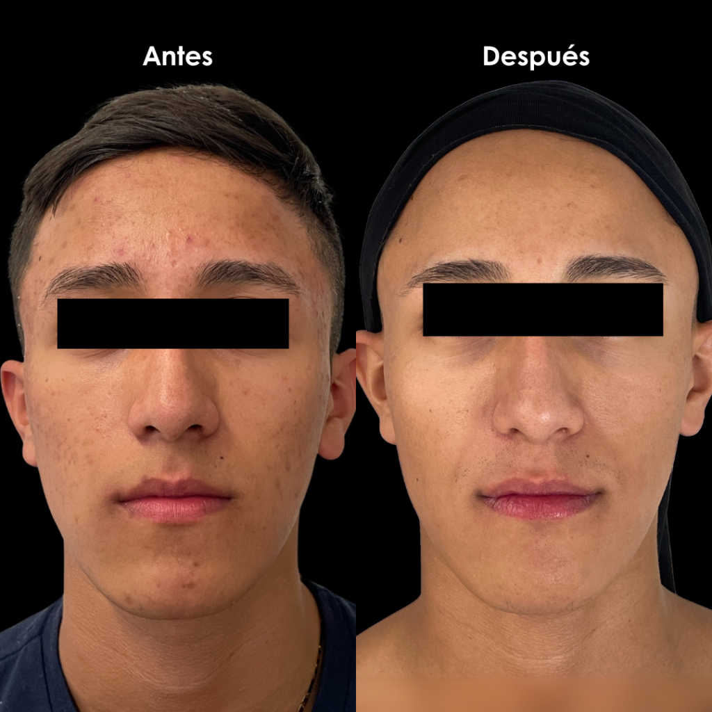 cicatrices de acne