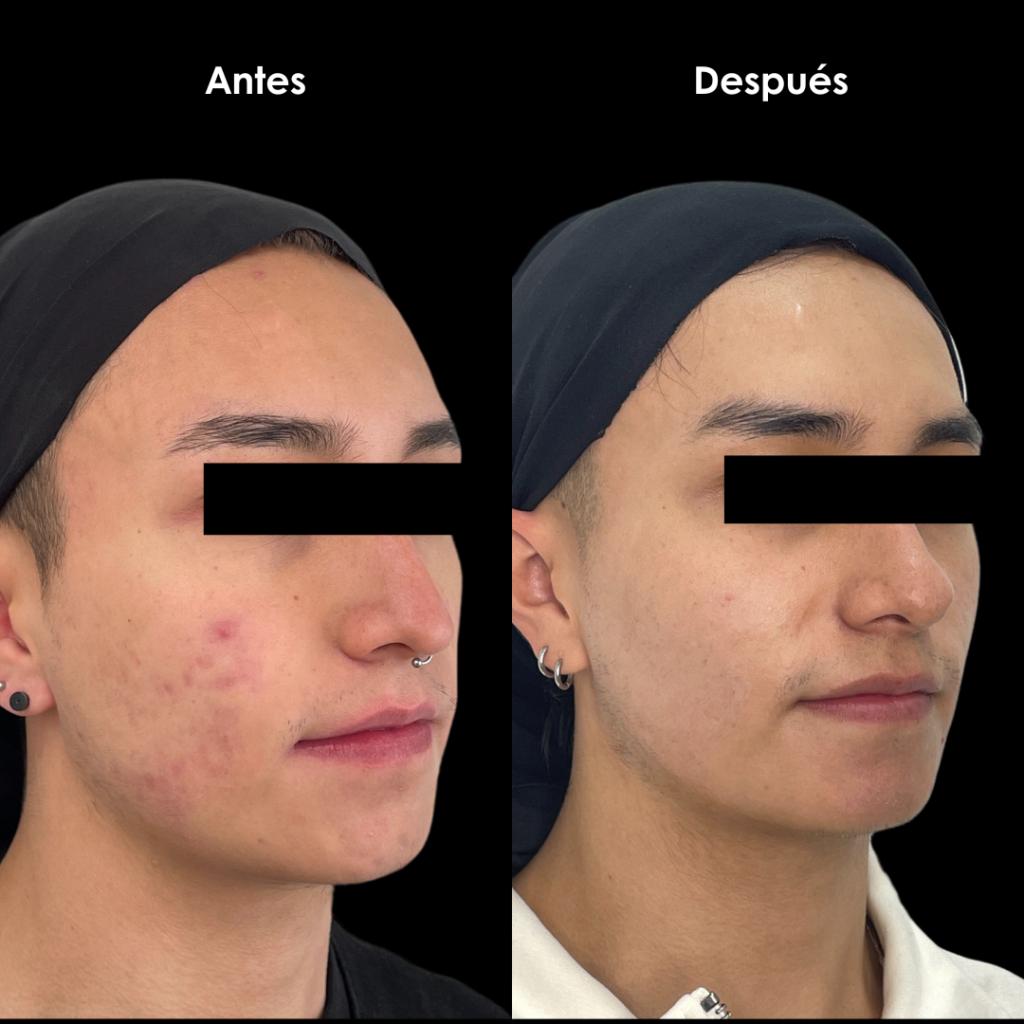 eliminar cicatrices de acne