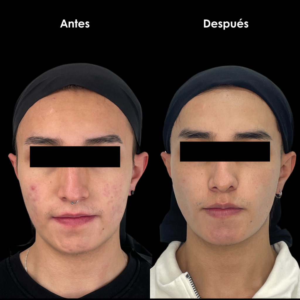 cicatrices de acne